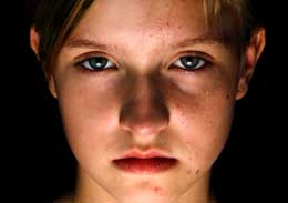 Girl with acne