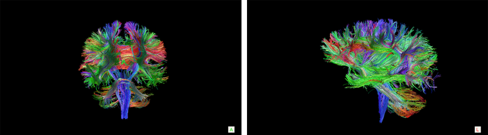 Diffusion tensor images of a stroke participant&rsquo;s brain showing structural connections and colour-coded pathways by direction.